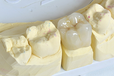 A model of teeth with a porcelain crown