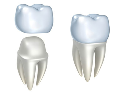 A diagram of a dental crown