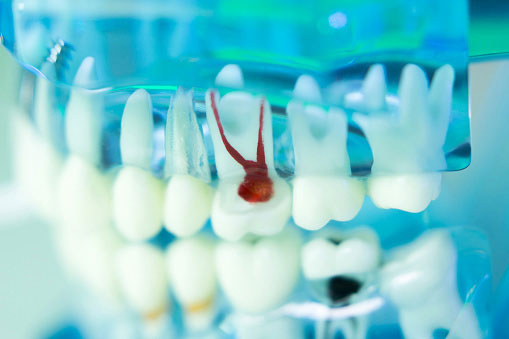 Translucent model of teeth showing red roots of a decaying tooth at Parkside Dental in Murphy, TX 75098