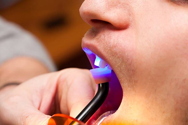  Patient undergoing a dental bonding procedure