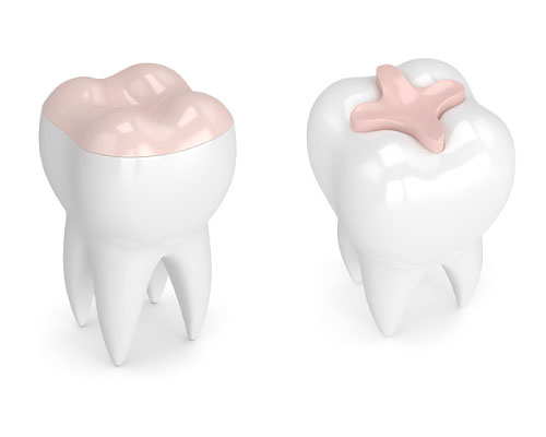 A diagam of teeth with an inlay and onlay