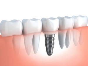 A diagram of teeth and a dental implant
