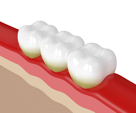 A diagram of infected gums