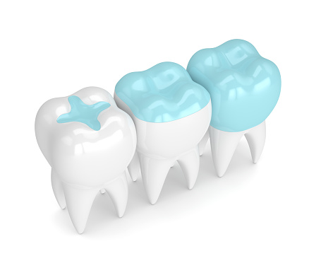 3D rendering of three teeth, one each with an inlay, onlay, and dental crown