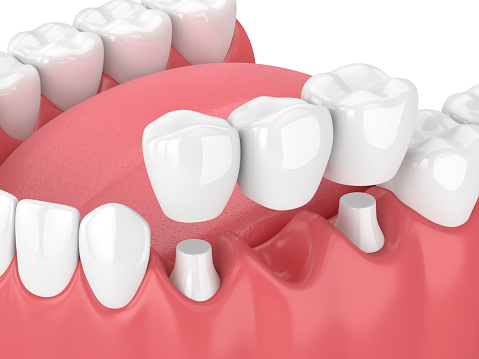 A diagram of a dental bridge