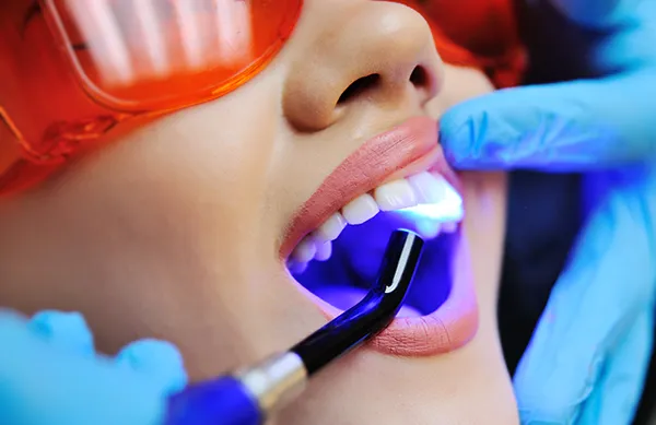 Close up of a dental assistant applying a UV light to a female patient's newly sealed teeth