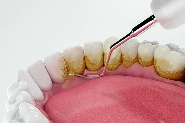 Close up 3D rendering of dirty teeth being cleaned and restored by a dental tool