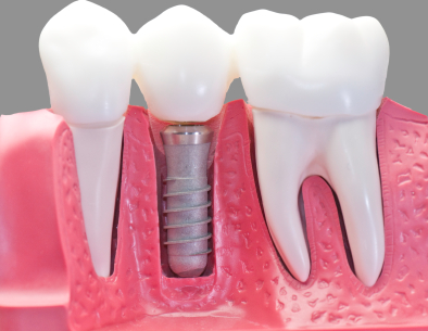 Model of a dental crown