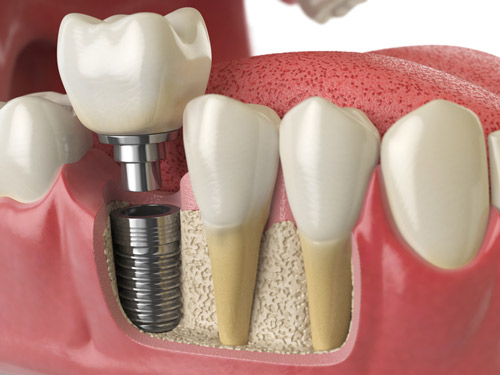 Rendering of dental implant cross-section at Parkside Dental